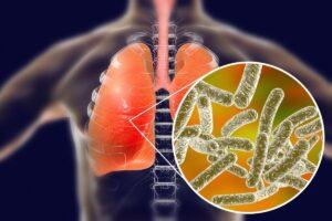 legionnaires disease