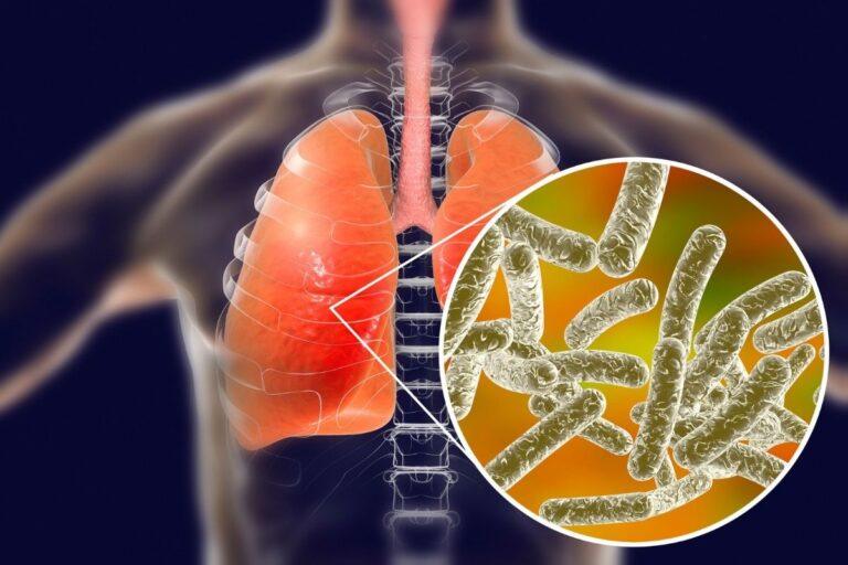 legionnaires disease